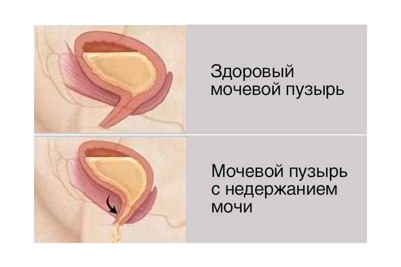 недержание-мочи.jpg